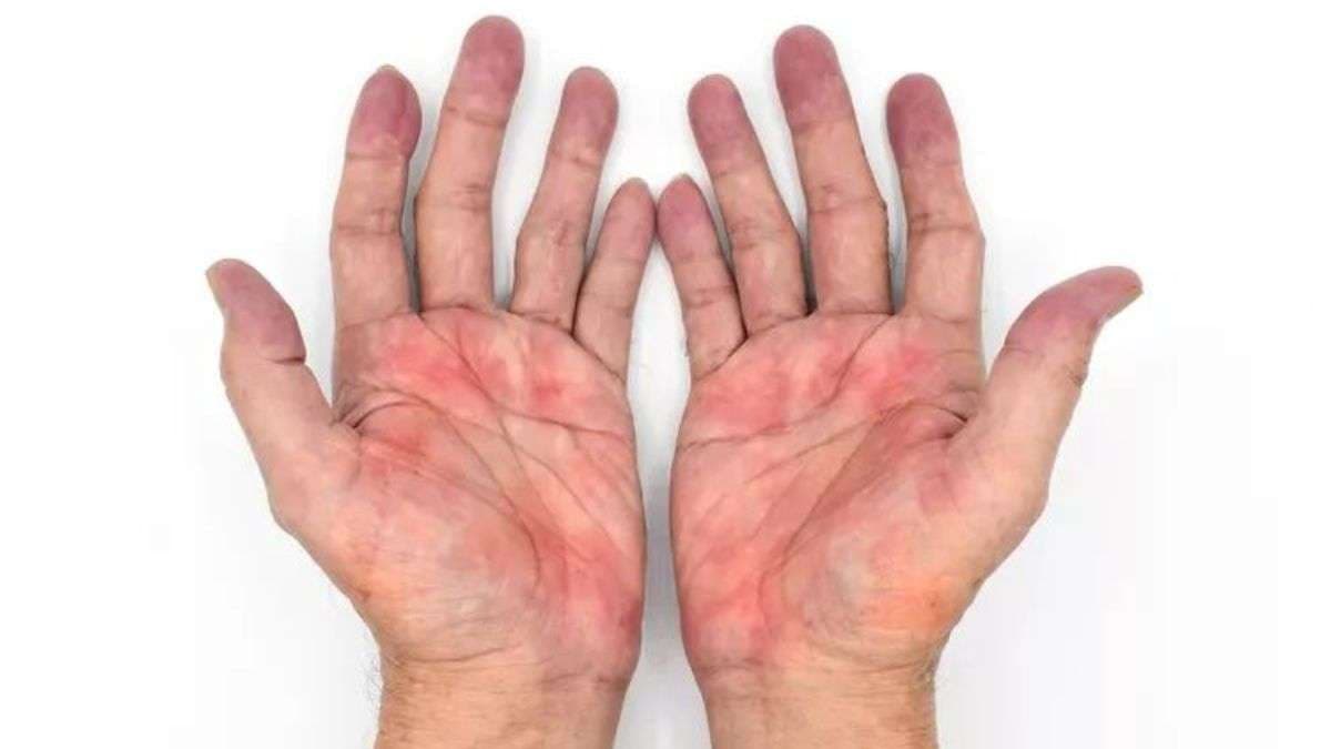 Liver disease symptoms: Lesser-known signs of the fatal condition that can show up on your hands